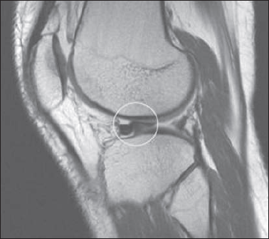 Sagittal PD sequence: Flipped fragment sign in bucket handle tear