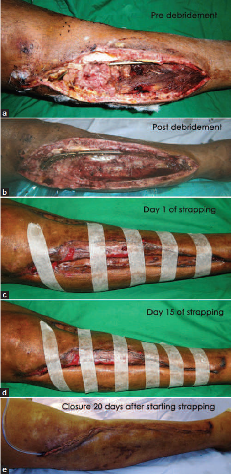 (a) Clinical photograph of 34 year male shows infection, slough and necrotic soft tissue with implant in situ with large soft tissue gap, (b) Clinical picture immediate after debridement, (c) Strapping was done from the first day (d) Continued with subsequent dressing, (e) Finally, closure of the wound was achieved on 20th day