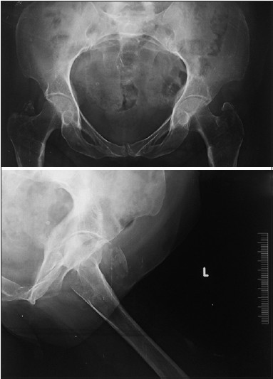 X-ray pelvis anteroposterior view shows B/L avulsion fracture GT