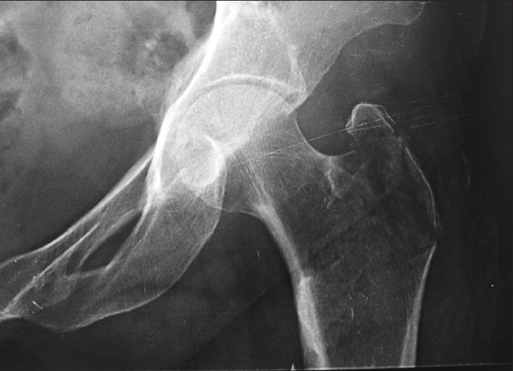 X-ray left hip joint anteroposterior view shows avulsion GT