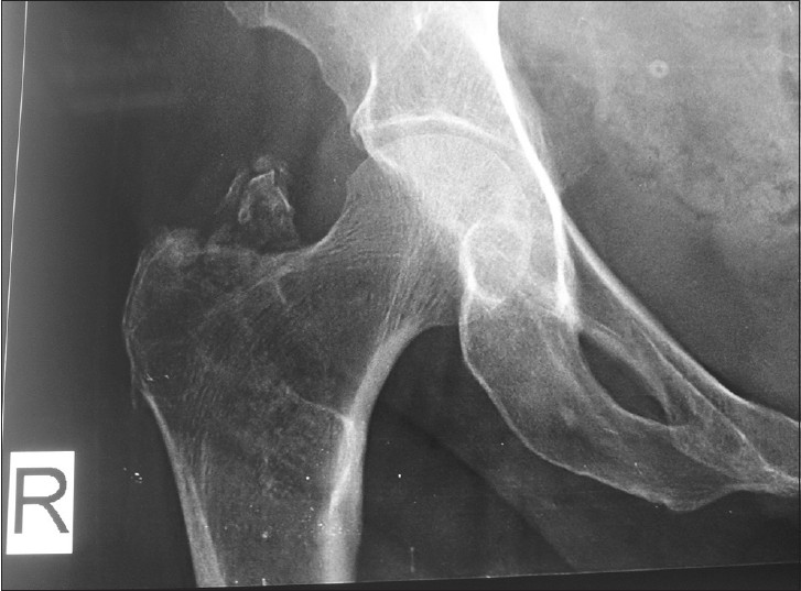 X-ray right hip joint anteroposterior view shows avulsion GT