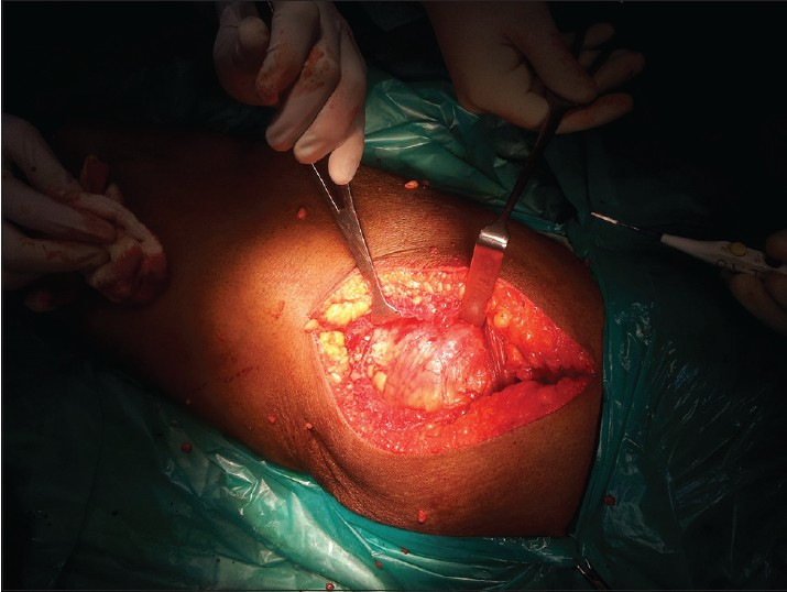 Intraoperative picture shows trochanteric bursa