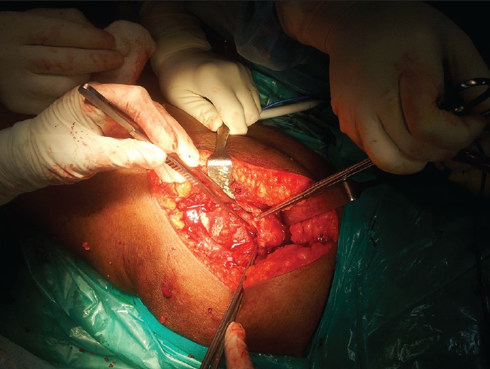 Intraoperative picture shows trochanteric bursa excision and fixation with TBW