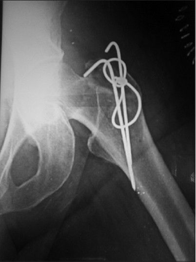 Postoperative X ray shows Greater T fixation with TBW