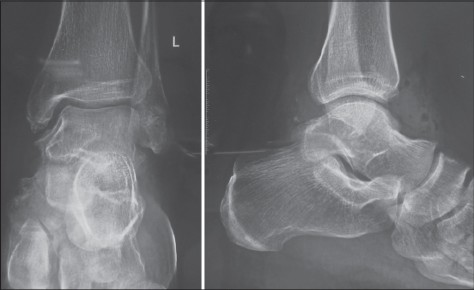 Normal post-operative radiograph of the same patient