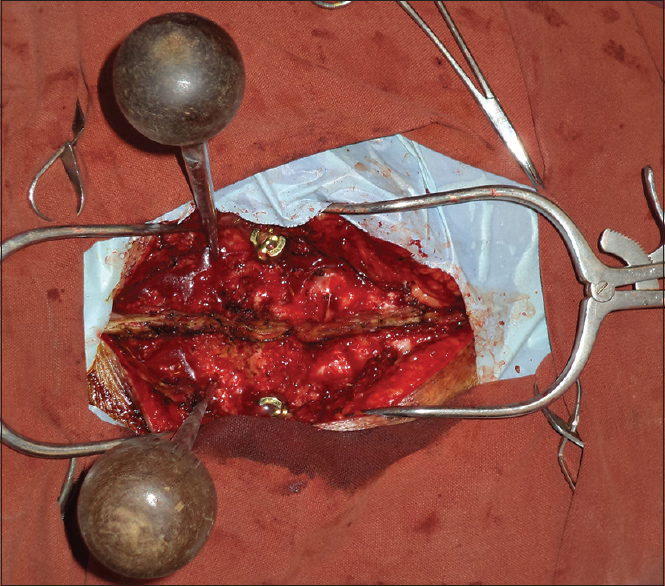 Intra-operative photograph showing two awls were placed in both right and left pedicle