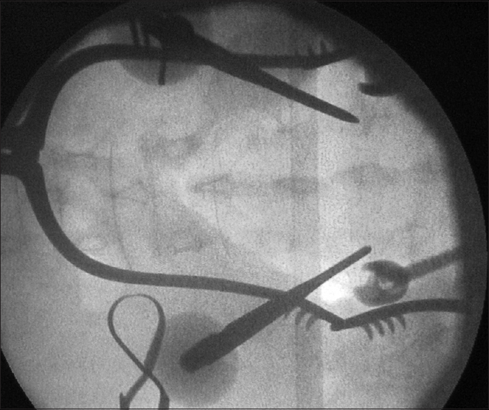 Intra-operative fluoroscopy confirmed the position of the awls