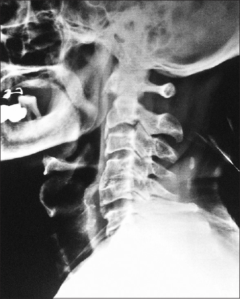 Radiograph of the cervical spine lateral showing diffuse degenerative changes, fracture of the C2–3 and C5–6 anterior osteophyte, C4–5 bridging osteophytes, and intervertebral disc calcification