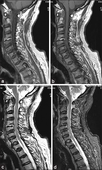 Magnetic resonance imaging (MRI) cervical spine (a and b) T1-weighted (T1W), (c) T2W, and (d) fluid-attenuated inversion recovery (FLAIR) images showing hyperintense C4–5 intervertebral disc