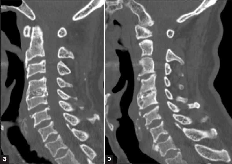 Computed tomography (CT) scan cervical confirmed that the hyperintense appearance of intervertebral disc was due to extensive calcification