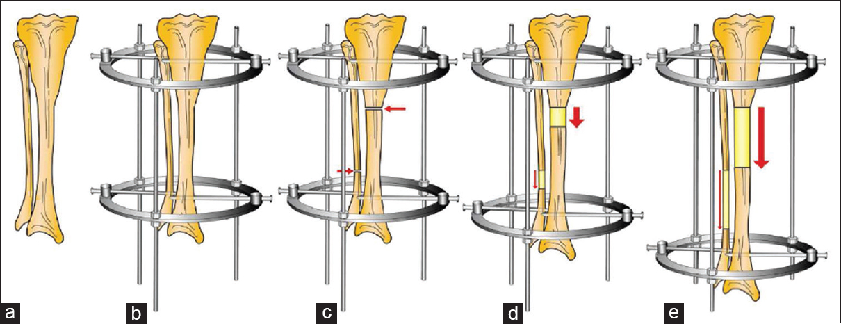 The bone is encased by the Ilizarov device during the gradual phases in distraction osteogenesis. (a) The bone to be lengthened; (b) Ilizarov device application; (c) proximal tibia osteotomy; (d) beginning of the distraction and (e) end of distraction