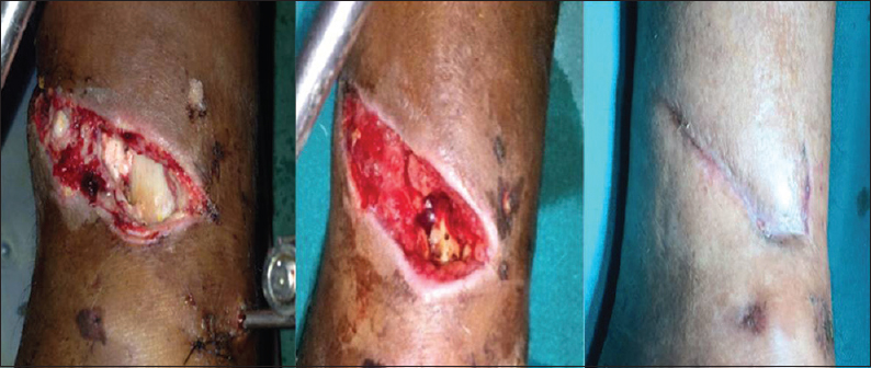 A 27-year-old male, 1 month old compound infected fracture of left tibia, previously failed treatment by vacuum assisted device: Complete healing after 5 Sandeep's technique for assisted regeneration of skin therapy session