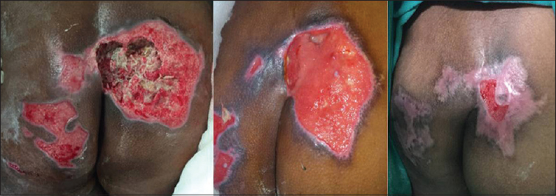 A 67-year-old female with a bone-deep pressure sore: Near complete healing after 5 Sandeep's technique for assisted regeneration of skin session