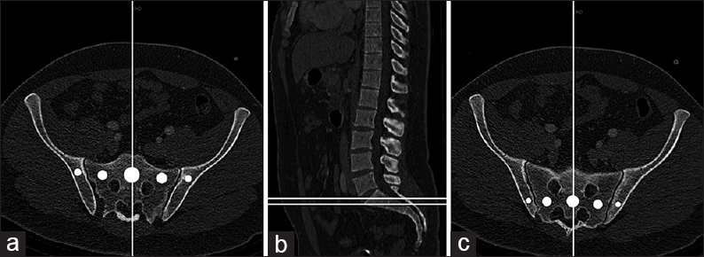 Cross-referencing and region of interests on level S1 (a) and S2 (c), with corresponding height in the sagittal plane. (b) Key areas from left to right: Right os ilium (R), right massa lateralis of os sacrum (RM), center of vertebral body (c), left massa lateralis of os sacrum (LM), left os ilium (L)