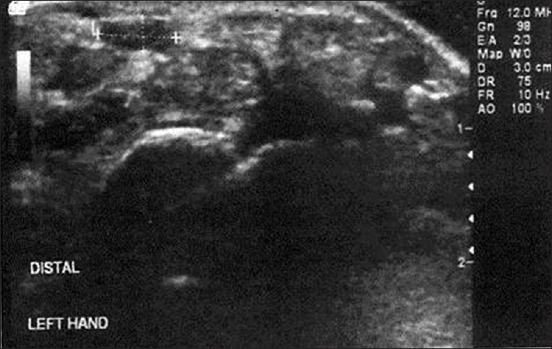 USG in the distal part of carpal tunnel showing indirect method of measuring cross-sectional area