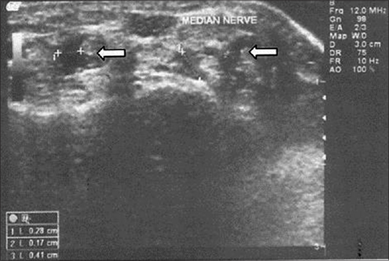 USG in a 52 years old female with carpal tunnel syndrome showing marked synovial thickening around the flexor tendons