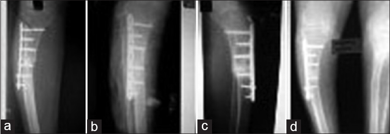 (a) Nonunions with implant in situ; (b-d) after bone marrow concentrate injection; (d) showing consolidation (latest follow-up) (case 3)