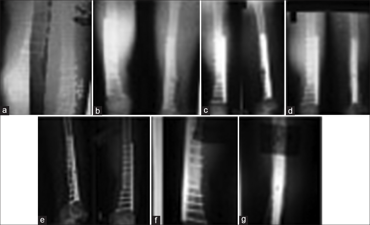 (a and b) Nonunions with implant in situ; (c-g) after bone marrow concentrate injection (f); (g) showing consolidation (latest follow-up) (case 4)