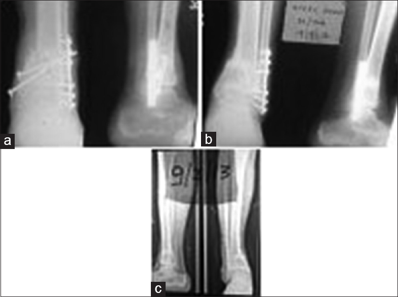 (a) Nonunions with implant in situ; (b and c) after bone marrow concentrate injection; (c) showing consolidation (latest follow-up) (case 7)