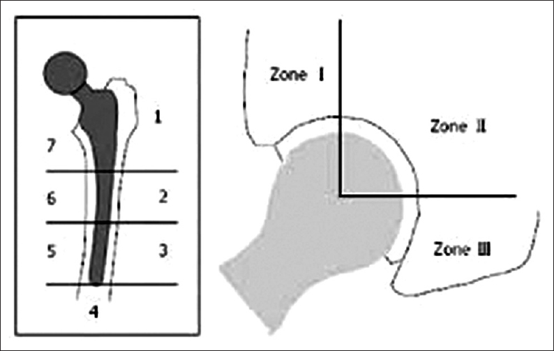 Zone system used by Gruen et al