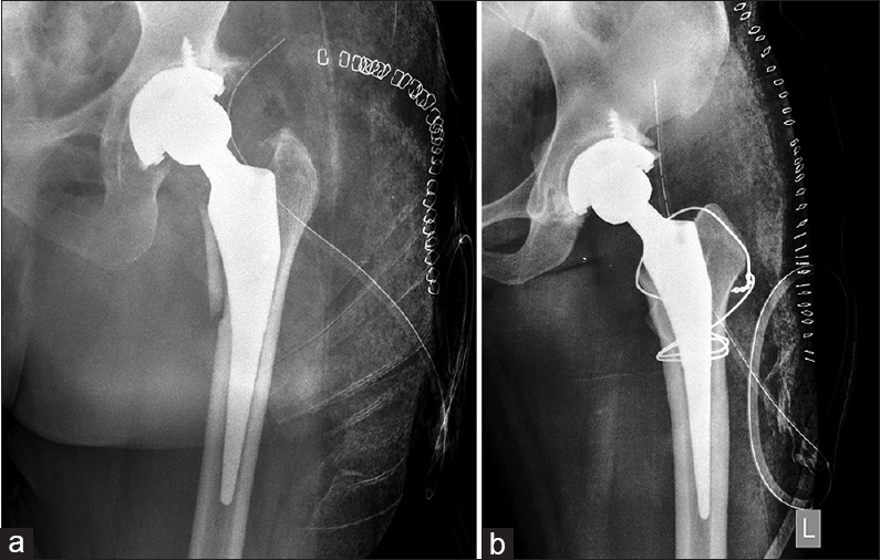 (a) Intra-operative hoop stress fractures of proximal femur. (b) Intra-operative hoop stress fractures of proximal femur with cerclage wire