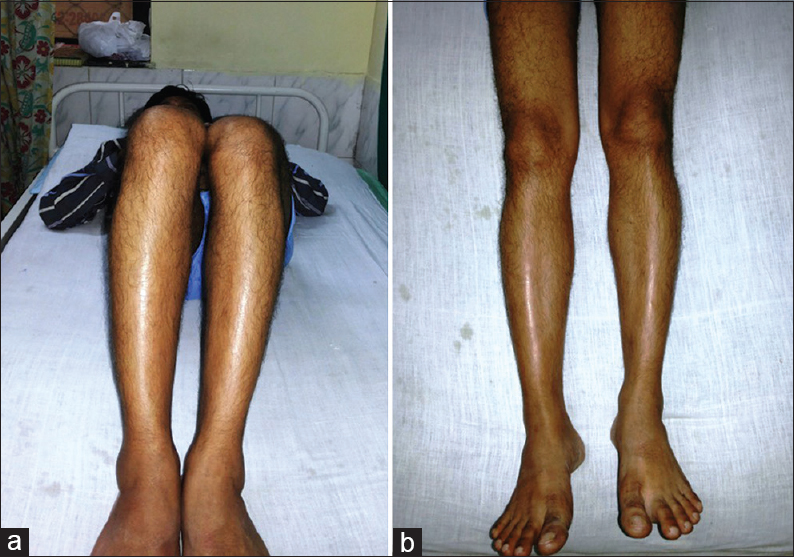 (a) Post Total hip arthroplasty leg length discrepancy. (b) Post Total hip arthroplasty leg length discrepancy