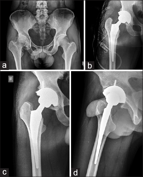 (a) Pre operative x ray of pelvis with both hips showing right hip arthritis in 31 years male. (b) Immediate post operative X ray after cement-less total hip arthroplasty. (c) X ray right hip AP view at 3 yrs follow up with no signs of osteolysis, subsidence or loosening. (d) X ray right hip lateral view at 3 years follow up with no signs of osteolysis, subsidence or loosening