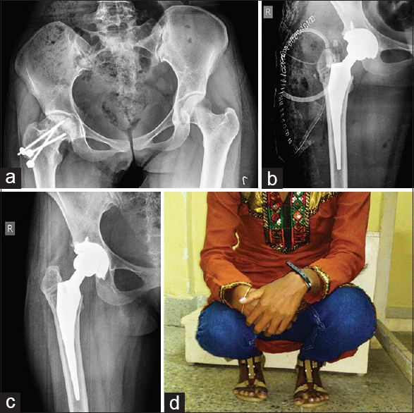 (a) Pre operative X ray of pelvis with both hips showing post traumatic right hip arthritis in 20 years female. (b) Immediate post operative X ray after cement-less total hip arthroplasty. (c) X ray right hip AP view at 4 yrs follow up with no signs of osteolysis, subsidence or loosening. (d) Clinical result at 4 yrs follow up showing almost complete range of motion