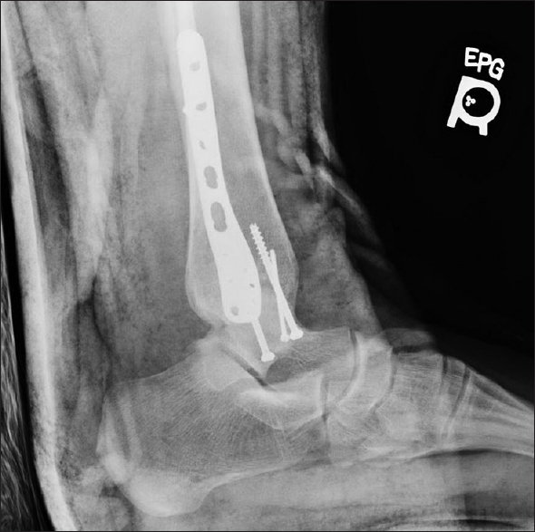 Plain radiograph of the ankle lateral view