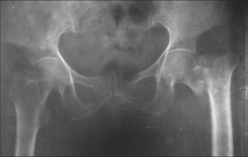 A 68-year-old female of unstable intertrochanteric fracture femur right sides