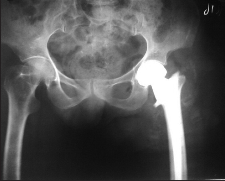 A case of 68-year-old female of unstable intertrochanteric fracture femur treated by cemented bipolar hemiarthroplasty