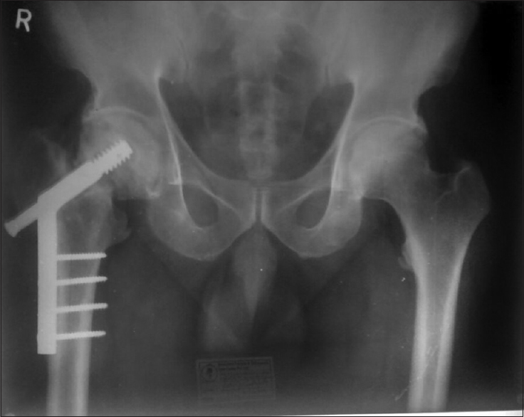 A 56-year-old male patient of failed case of intertrochanteric fracture femur treated by dynamic hip screw 1 year back