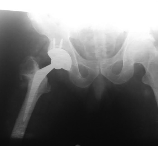 A 56-year-old male patient of failed case of intertrochanteric fracture femur treated by dynamic hip screw 1 year back treated by uncemented total hip arthroplasty