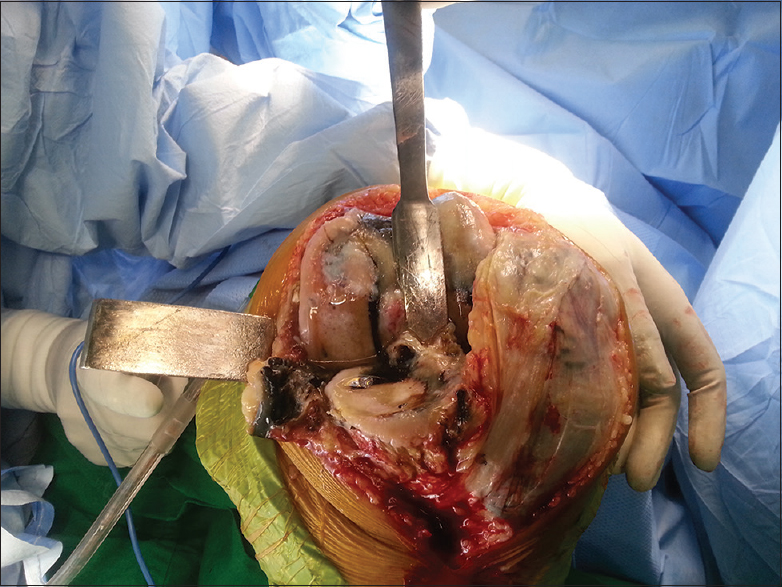 Intraoperative clinical photograph of the right knee joint showing brownish-black discoloration in ligaments, capsule, synovium, and meniscus