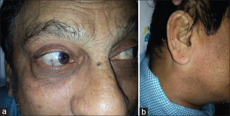 Clinical photograph of patient showing mild bluish-brown pigmentation in sclera (a) and base of pinna (b), which was appreciated only after thorough proper examination and high index for suspicion for alkaptonuria