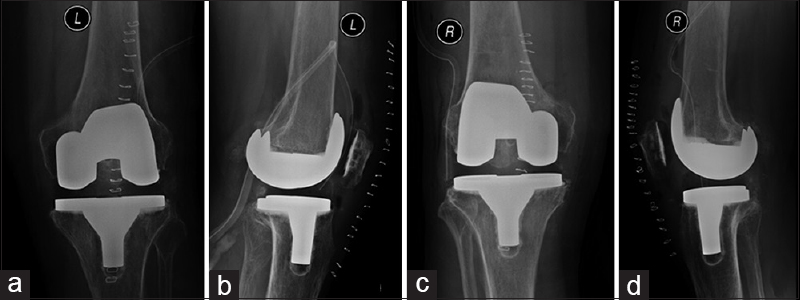 Postoperative anteroposterior (a and c) and lateral (b and d) X-rays of the left right and left knee revealing valgus alignment in both the knees with total knee components in good position and alignment, respectively