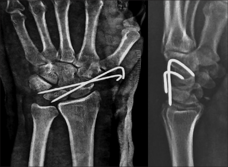 Frontal and lateral wrist radiograph after open reduction and metal pin fixation showing repositioning of scaphoid