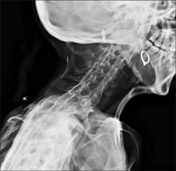 The cervical spine showed expansion of the posterior column of cervical vertebrae with calcification and bony fusion and ossified bridge between chin and sternum