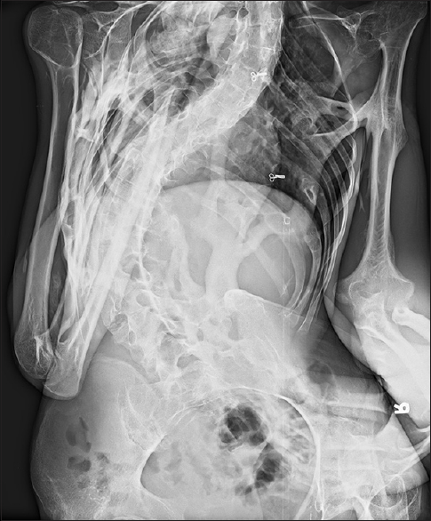 Lumbosacral spine showed severe scoliosis with heterotopic ossification of soft tissues dorsally