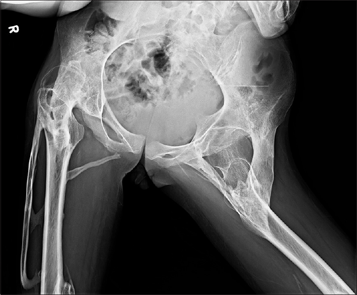 Pelvis showed ossified bridges around the hip joints, extending from the ischium to the greater and lesser trochanters and to the proximal shaft of femur