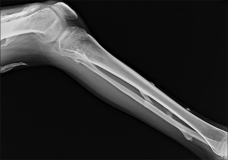 Radiograph of leg showing multifocal heterotopic ossification