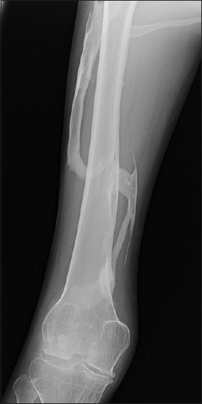 Radiograph of thigh showing multifocal heterotopic ossification