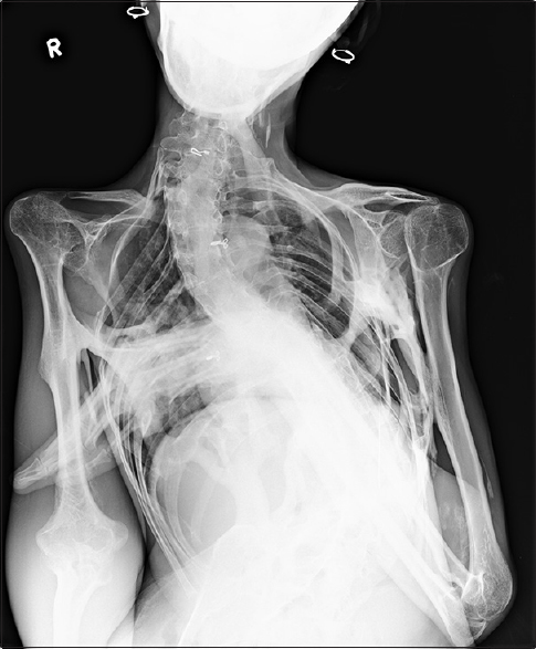 Thorax showed extensive multifocal heterotopic ossification and osseous bridging between ribs and ossified bridging of the right humerus