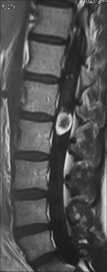 T1-weighted sagittal magnetic resonance imaging showing hyperintense isolated lesion behind L1-L2 bodies