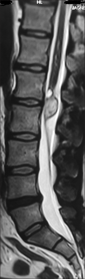 T2-weighted sagittal magnetic resonance imaging showing isointense lesion