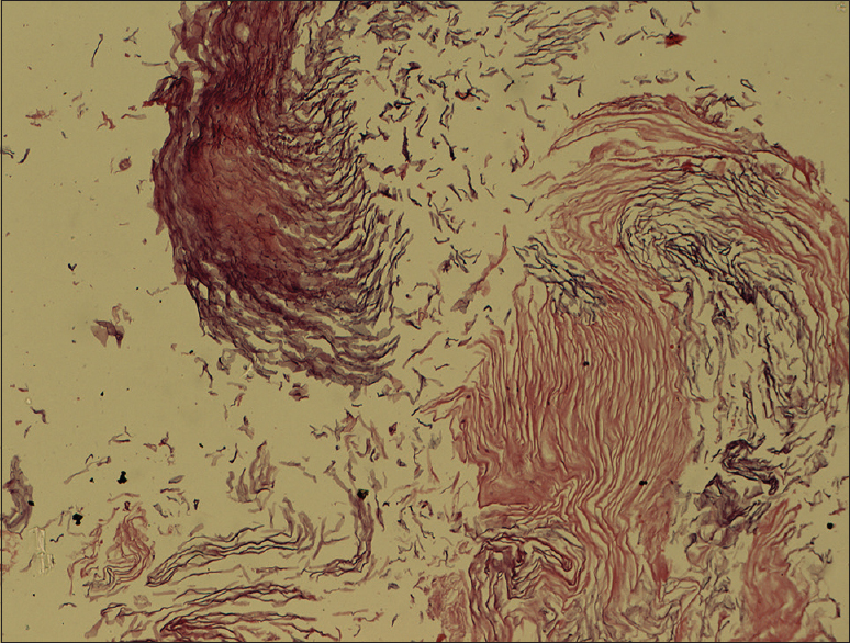 Histopathologic examination showed cystic lesion lined by keratinized stratified squamous epithelium and lumen filled with keratinous material. The stroma showed fibro-adipose tissue