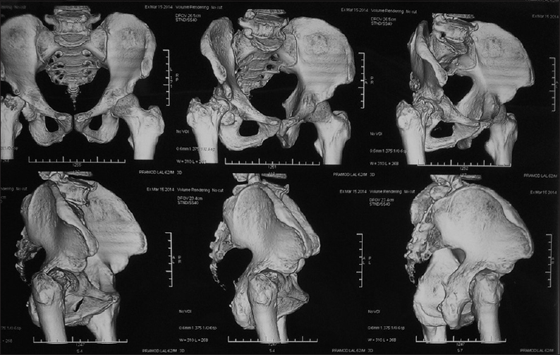 Computed tomography scan of the pelvis with bilateral hips with three-dimensional image reconstruction showing non visualization of the right femoral head