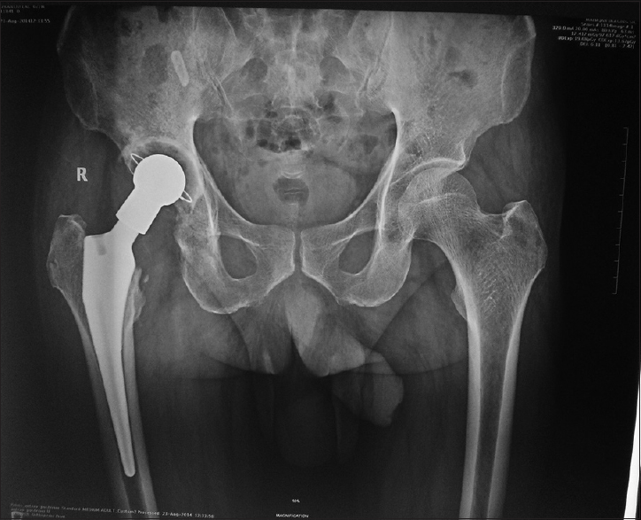 X-ray of the pelvis with bilateral hips in anteroposterior view showing reverse hybrid total hip replacement of the right side