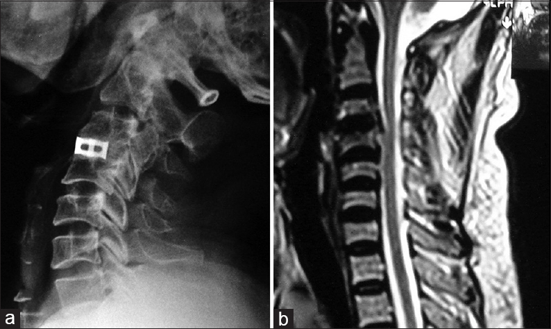 (a) X-ray of the cervical spine lateral view showing titanium cage in situ with good and solid bony fusion at C3-C4 level, note the posterior osteophytes and ossified ligamentum, (b) Magnetic resonance imaging T2-weighted image showing mild cord compression and calcified ligamentum