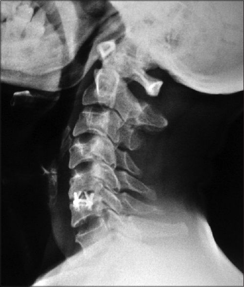 X-ray of the cervical spine lateral view of another patient showing titanium cage subsidence